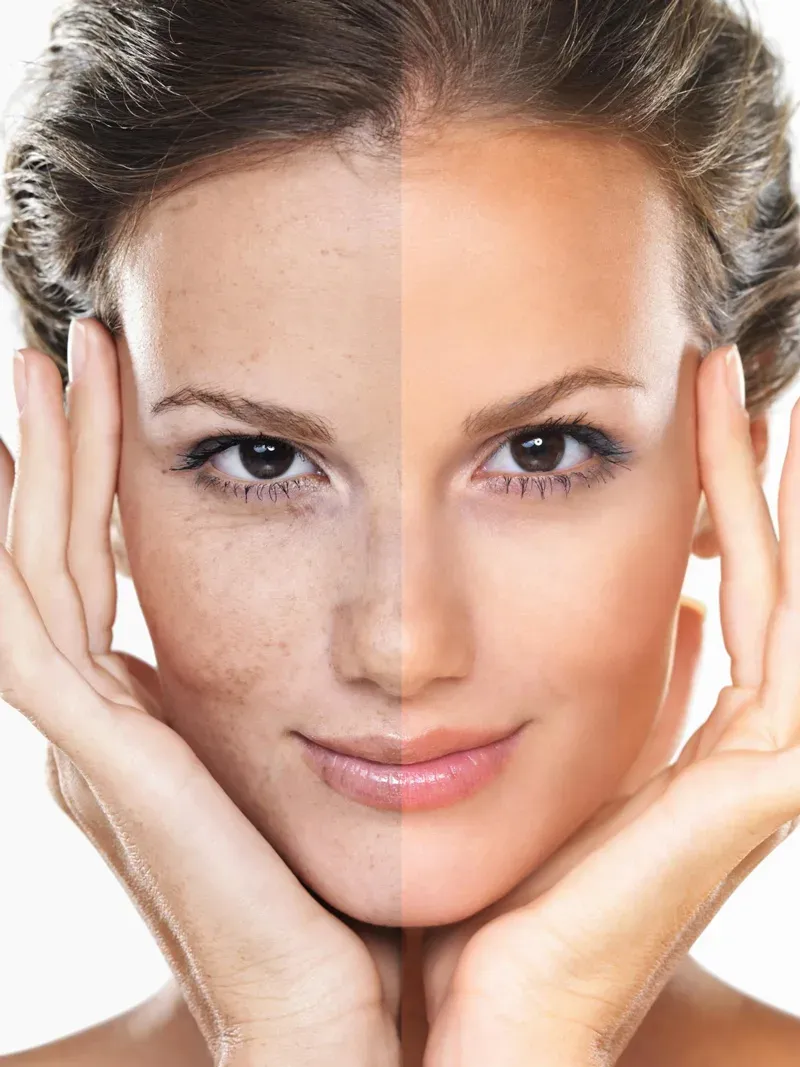 HydraFacial in Österreich
